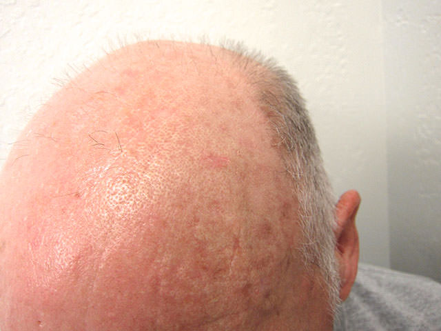 日光性角化症,actinic keratosis