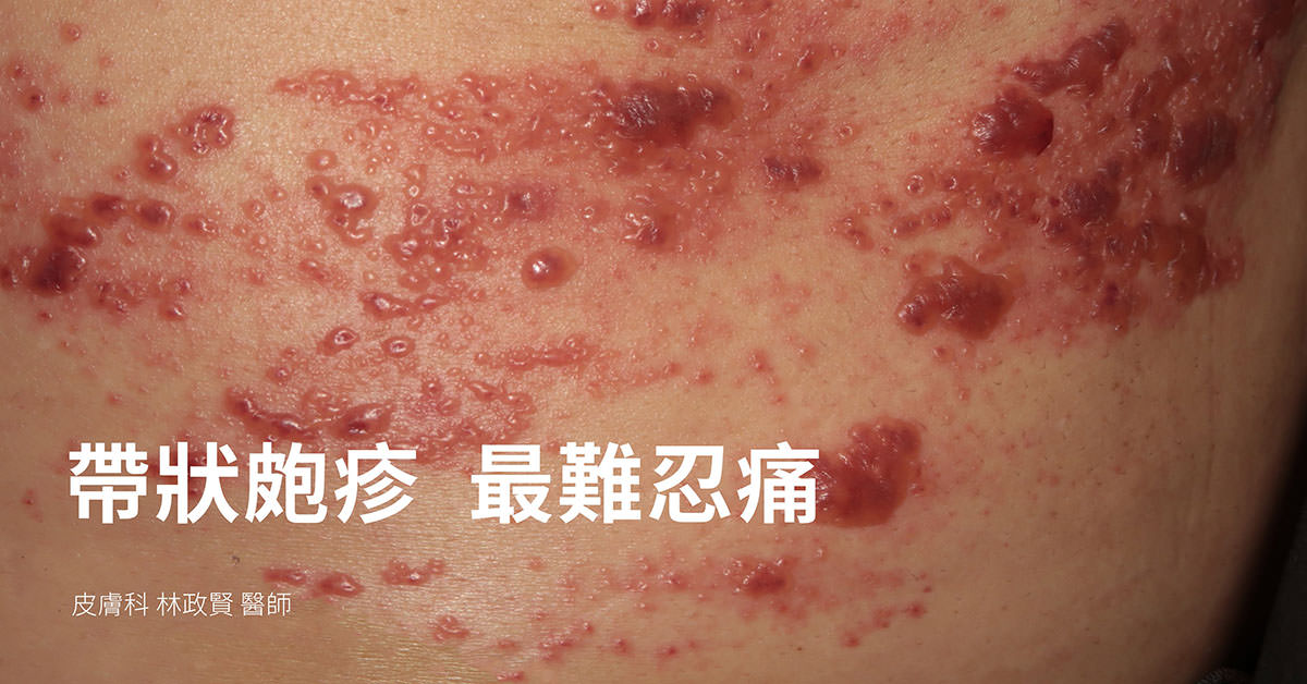 帶狀皰疹,帶狀疱疹,herpes zoster,皮蛇,shingles,斬蛇