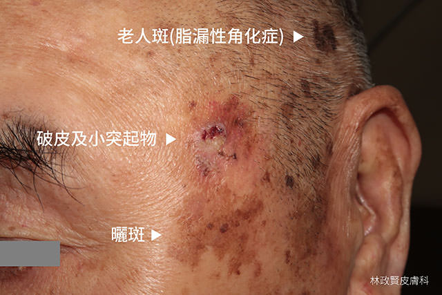 皮膚癌,skin cancer,雷射除斑,鱗狀細胞癌,squamous cell carcinoma,日光性角化症