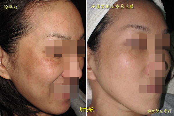 肝斑,黑斑,孕斑,melasma,chloasma,淨膚雷射,高雄皮秒雷射,discovery pico,黃金蜂巢,picosure,picoway,picocare,picoq