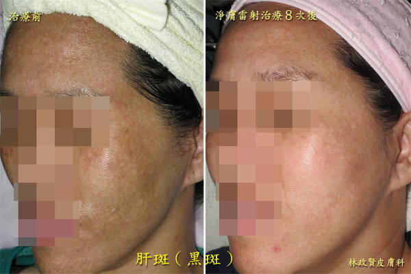 肝斑,黑斑,孕斑,melasma,chloasma,淨膚雷射,高雄皮秒雷射,discovery pico,黃金蜂巢,picosure,picoway,picocare,picoq