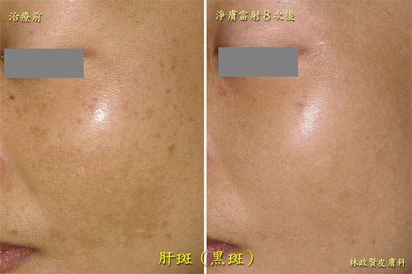 肝斑,黑斑,孕斑,melasma,chloasma,淨膚雷射,高雄皮秒雷射,discovery pico,黃金蜂巢,picosure,picoway,picocare,picoq