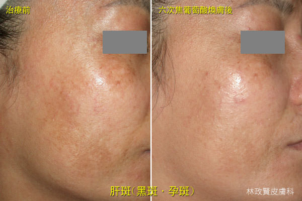 肝斑,黑斑,孕斑,melasma,chloasma,淨膚雷射,高雄皮秒雷射,discovery pico,黃金蜂巢,picosure,picoway,picocare,picoq,焦葡萄酸換膚