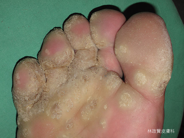 病毒疣,足底疣,蹠疣,verruca,vulgaris,plantaris,MMR,疫苗,免疫療法,抵抗力,酚瑞淨,樂得美,aldara,veregen