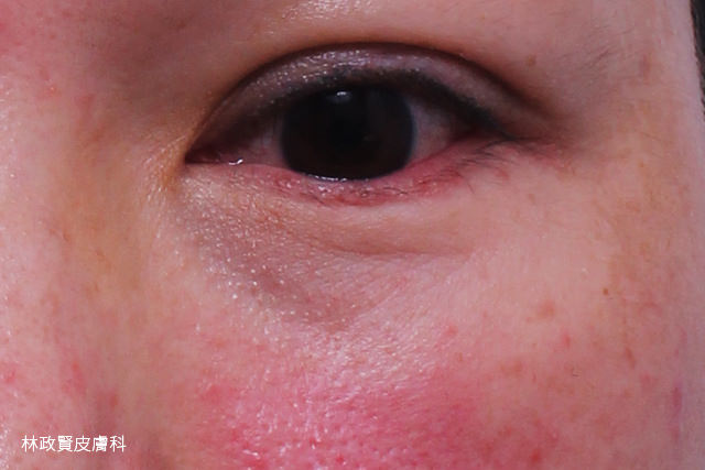 酒糟,眼睛型酒糟,ocular rosacea