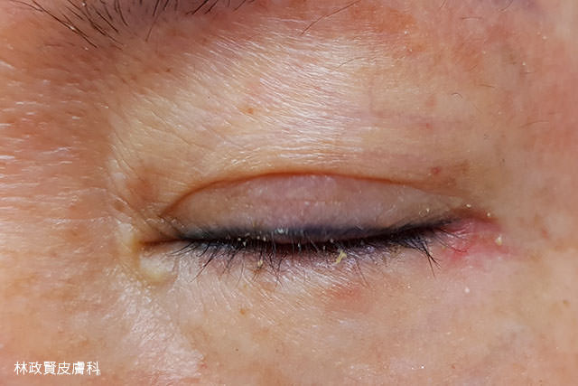 酒糟,眼睛型酒糟,ocular rosacea