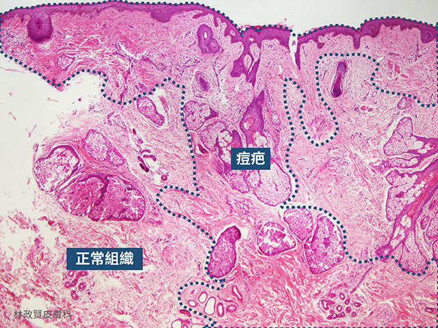 痘疤,凹洞,凹疤,皮下切割,皮下剝離,subcision