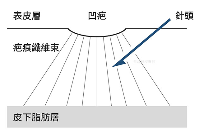 痘疤,凹洞,凹疤,皮下切割,皮下剝離,subcision