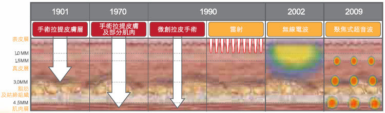 ulthera,ultherapy,極線音波拉皮,極線音波拉提,緊膚