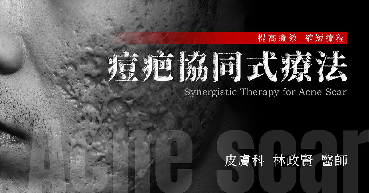 痘疤,協同式療法,協同式痘疤療法,synergy,acne,scar,凹洞,凹疤,高雄痘疤推薦