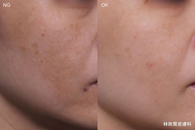 肝斑,孕斑,黑斑,melasma,探索皮秒雷射