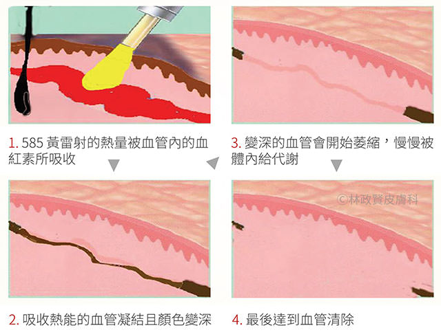 林政賢醫師,探索皮秒雷射