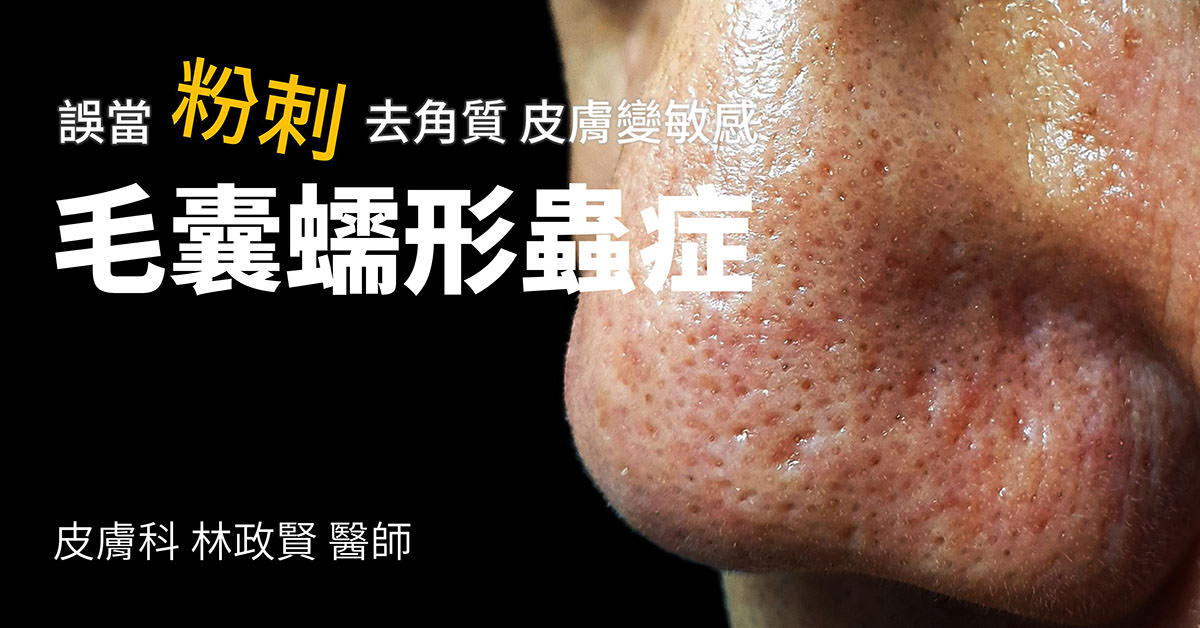 毛囊蠕形蟲症,demodicosis,demodex,粉刺