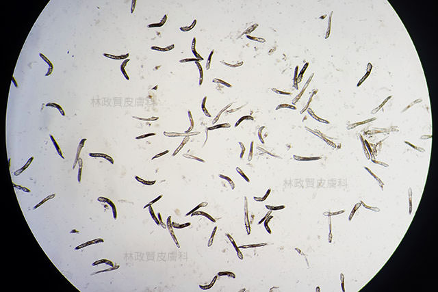 demodex,demodicosis,毛囊蠕形蟲症,顯微鏡