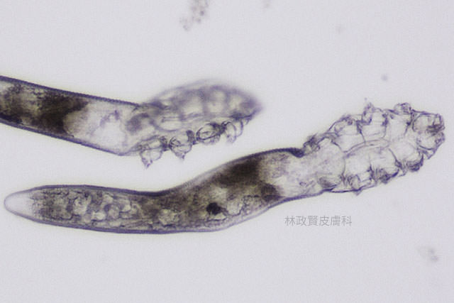 demodex,demodicosis,毛囊蠕形蟲症,顯微鏡