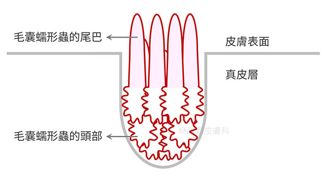 demodex,demodicosis,毛囊蠕形蟲症,顯微鏡