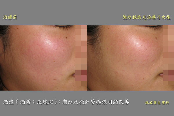 酒糟,臉紅,rosacea,強力脈衝光soolantra,ivermectin,舒利達