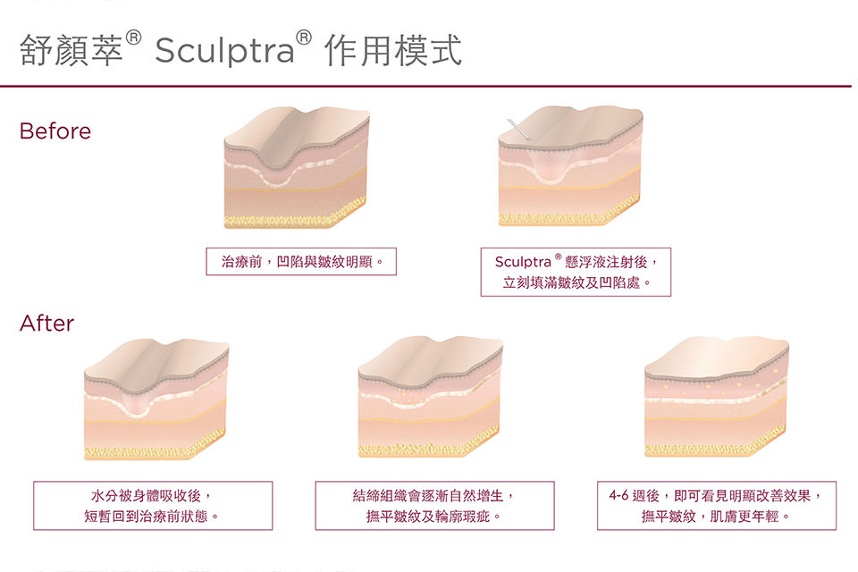 舒顏萃,Sculptra