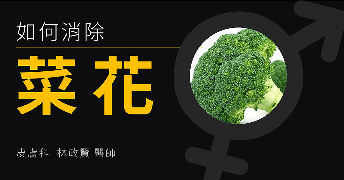 veregen,酚瑞淨,菜花,肛門,尖頭濕疣,尖圭濕疣,尖型濕疣,尖形濕疣,condyloma,樂得美,polyphenone E,兒茶素,抗氧化,免疫療法,catechin