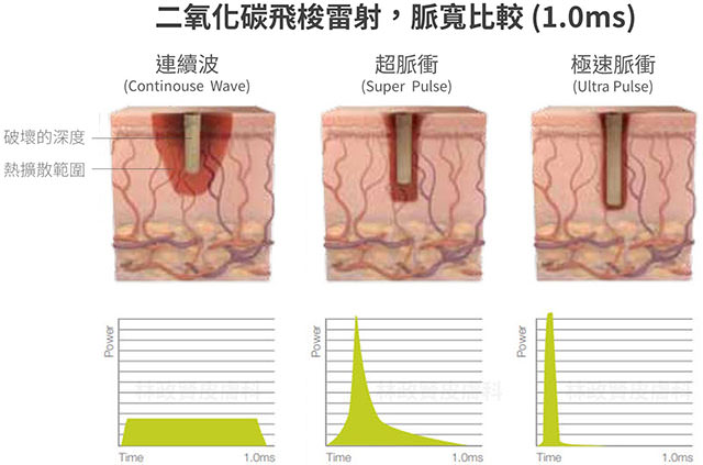 Ultra pulse,up雷射,痘疤,疤痕,外傷疤痕,燒燙傷疤痕高雄UP雷射推薦