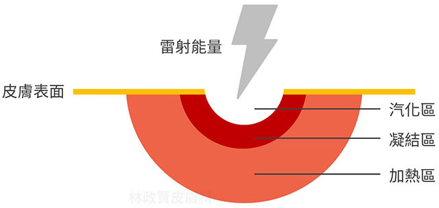 Ultra pulse,up雷射,痘疤,疤痕,外傷疤痕,燒燙傷疤痕高雄UP雷射推薦