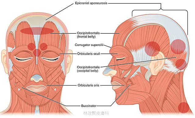 肉毒桿菌素,慢性偏頭痛,chronic migraine,botox,botulinum toxin,xeomin,dysport