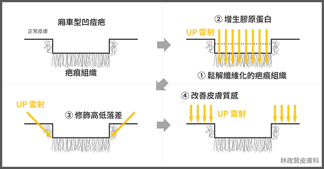 Ultra pulse,up雷射,凹痘疤,車廂型痘疤,冰鑿型痘疤,滾動型痘疤,疤痕,外傷疤痕,燒燙傷疤痕高雄UP雷射推薦