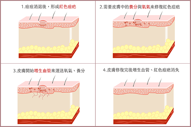 紅痘疤,紅痘印,紅色痘疤,紅色痘印,脈衝染料雷射,強力脈衝光,585黃雷射,577琥珀雷射,杜鵑花酸