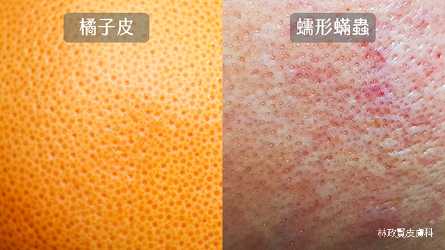 酒糟,蠕形蟎蟲,蠕型蟎蟲,demodex,demodicosis,舒利達,舒立達,soolantra,酒渣,玫瑰斑