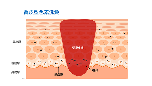 青春痘,痘疤,黑疤,黑痘疤,黑痘印,紅痘疤,紅痘印,紅疤,染料雷射,黃雷射,皮秒雷射,探索皮秒雷射,585黃雷射,凹疤,凹洞,UP雷射,ultrapulse,皮下剝離,皮下切割,subcision,真皮移植,凹疤提升術,穿刺提升術,punch,elevation,褐痘疤,凹痘疤,飛梭雷射,發炎反應,免疫抑制劑,杜鵑花酸,外用A酸,口服A酸,光動力,黑色痘疤,黑色素沉澱,表皮型色素沉澱,真皮型色素沉澱