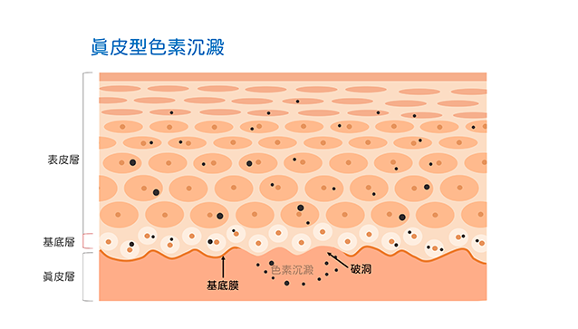 青春痘,痘疤,黑疤,黑痘疤,黑痘印,紅痘疤,紅痘印,紅疤,染料雷射,黃雷射,皮秒雷射,探索皮秒雷射,585黃雷射,凹疤,凹洞,UP雷射,ultrapulse,皮下剝離,皮下切割,subcision,真皮移植,凹疤提升術,穿刺提升術,punch,elevation,褐痘疤,凹痘疤,飛梭雷射,發炎反應,免疫抑制劑,杜鵑花酸,外用A酸,口服A酸,光動力,黑色痘疤,黑色素沉澱,表皮型色素沉澱,真皮型色素沉澱