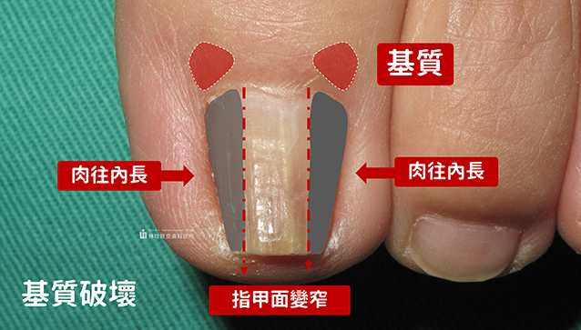 指甲矯正,問題指甲,咬指甲,矯正指甲,凝膠指甲,水晶指甲,甲床剝離,甲肉萎縮,甲床分離,硬繭,扇形指甲,嵌甲矯正器,鎳鈦合金,記憶金屬,不鏽鋼指甲矯正器,Spange,Podofix,Naspan,維持器,甲溝炎,凍甲,盪甲,當甲,指甲 化膿,剪指甲,Combiped,指甲脆弱,指甲矯正器,趾甲矯正器,3to,podofix,nail,brace,拔指甲,拔趾甲,spange,combiped,嵌甲,香港腳,足癬,黴菌感染,灰指甲,蜂窩性組織炎,汗皰疹,灰趾甲,灰指甲治療,灰指甲偏方,灰指甲預防,灰指甲顏色,onychomycosis,tinea unguium,變色指甲,athletes foot on hands,灰指甲藥膏,樂指力,嵌甲症,口服抗黴菌,外用抗黴菌,UP雷射,甲癬,手癬,股癬,胯下癢,3 to,甲床分離 治療,指甲脆弱 原因,里特指甲矯正器,里特,里特嵌甲矯正器,里特崁甲矯正器,鎳鈦指甲矯正器,nit,指甲倒插,指甲倒刺,肉芽,鎳鈦嵌甲矯正器,鎳鈦崁甲矯正器,nit spange brace,指甲手術