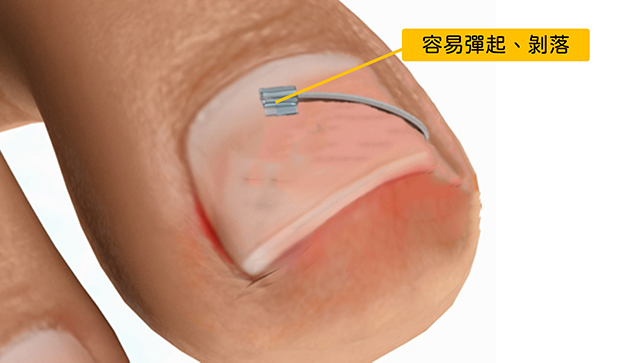 指甲矯正,問題指甲,咬指甲,矯正指甲,凝膠指甲,水晶指甲,甲床剝離,甲肉萎縮,甲床分離,硬繭,扇形指甲,嵌甲矯正器,鎳鈦合金,記憶金屬,不鏽鋼指甲矯正器,Spange,Podofix,Naspan,維持器,甲溝炎,凍甲,盪甲,當甲,指甲 化膿,剪指甲,Combiped,指甲脆弱,指甲矯正器,趾甲矯正器,3to,podofix,nail,brace,拔指甲,拔趾甲,spange,combiped,嵌甲,香港腳,足癬,黴菌感染,灰指甲,蜂窩性組織炎,汗皰疹,灰趾甲,灰指甲治療,灰指甲偏方,灰指甲預防,灰指甲顏色,onychomycosis,tinea unguium,變色指甲,athletes foot on hands,灰指甲藥膏,樂指力,嵌甲症,口服抗黴菌,外用抗黴菌,UP雷射,甲癬,手癬,股癬,胯下癢,3 to,甲床分離 治療,指甲脆弱 原因,里特指甲矯正器,里特,里特嵌甲矯正器,里特崁甲矯正器,鎳鈦指甲矯正器,nit,指甲倒插,指甲倒刺,肉芽,鎳鈦嵌甲矯正器,鎳鈦崁甲矯正器,nit spange brace