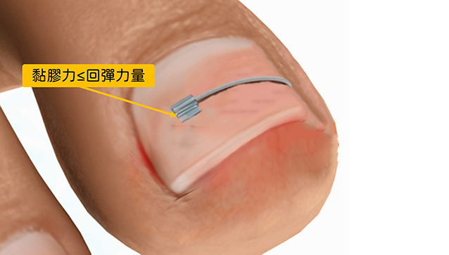 指甲矯正,問題指甲,咬指甲,矯正指甲,凝膠指甲,水晶指甲,甲床剝離,甲肉萎縮,甲床分離,硬繭,扇形指甲,嵌甲矯正器,鎳鈦合金,記憶金屬,不鏽鋼指甲矯正器,Spange,Podofix,Naspan,維持器,甲溝炎,凍甲,盪甲,當甲,指甲 化膿,剪指甲,Combiped,指甲脆弱,指甲矯正器,趾甲矯正器,3to,podofix,nail,brace,拔指甲,拔趾甲,spange,combiped,嵌甲,香港腳,足癬,黴菌感染,灰指甲,蜂窩性組織炎,汗皰疹,灰趾甲,灰指甲治療,灰指甲偏方,灰指甲預防,灰指甲顏色,onychomycosis,tinea unguium,變色指甲,athletes foot on hands,灰指甲藥膏,樂指力,嵌甲症,口服抗黴菌,外用抗黴菌,UP雷射,甲癬,手癬,股癬,胯下癢,3 to,甲床分離 治療,指甲脆弱 原因,里特指甲矯正器,里特,里特嵌甲矯正器,里特崁甲矯正器,鎳鈦指甲矯正器,nit,指甲倒插,指甲倒刺,肉芽,鎳鈦嵌甲矯正器,鎳鈦崁甲矯正器,nit spange brace