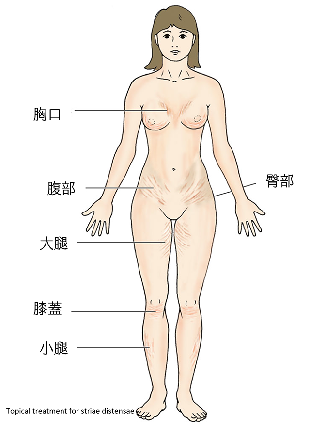 妊娠紋 治療,思膚安,矽谷電波,sylfirm,肥胖紋,生長紋,妊娠紋,妊娠紋 治療,Stria distensa,Stretch mark,Stria gravidatorum,妊娠霜,萎縮紋,懷孕,體重增加,白色妊娠紋,紅色妊娠紋,膠原蛋白,斑點,雀斑,太田母斑,顴骨母斑,曬斑,老人斑,保養品,藥物,雷射,治療斑點,外用A酸,黑色素,除斑,防曬,老化,光老化,色素沉澱,除斑雷射,雷射除斑,去除斑,消除斑點,,希思珮樂,探索皮秒,皮秒雷射,肝斑,黑斑,黃褐斑,荷爾蒙斑,孕斑,皮秒雷射,三合一美白藥膏,淨膚雷射,cyspera,希思佩樂,美白藥膏,傳明酸,老人斑,淡化斑點,檸檬,雷射術後反黑,希斯珮樂,希思珮樂,西斯佩樂,西思佩樂,西思珮樂,臉色黯沉,極速袪斑,去色斑,三合一美白藥膏,基底膜破損,微血管增生,染料雷射,585黃雷射,淨膚雷射,皮秒雷射