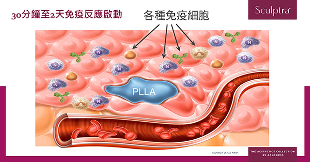 舒顏萃,sculptra,3D聚左旋乳酸,PLLA,把青春一點一滴找回來,減齡三部曲