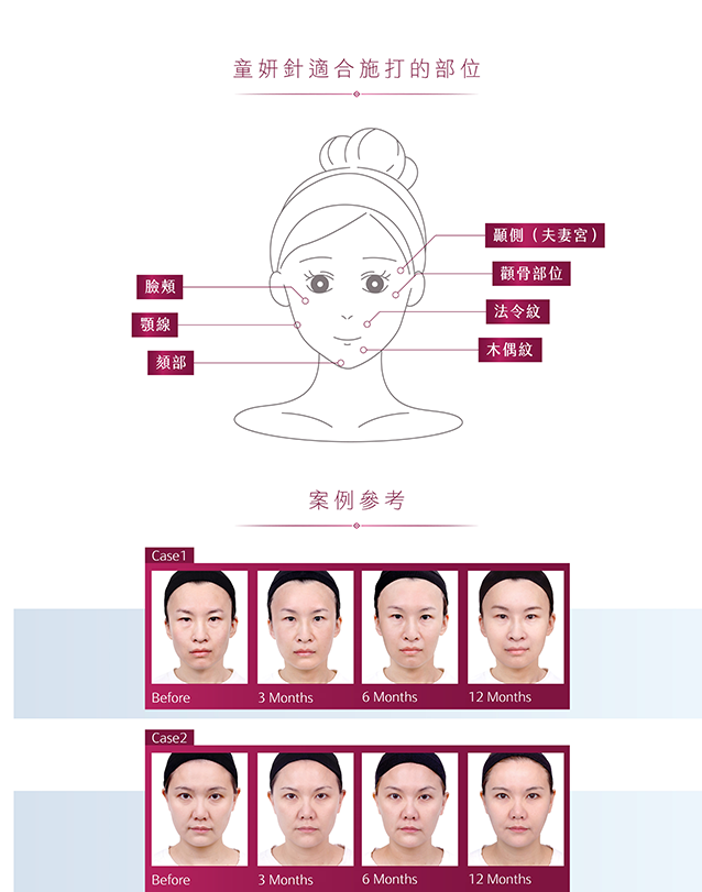 舒顏萃,sculptra,3D聚左旋乳酸,PLLA,把青春一點一滴找回來,減齡三部曲