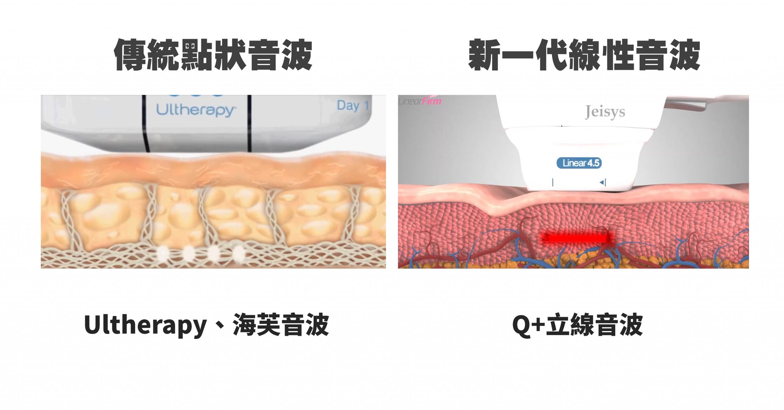 大s,天心,韓國,歐巴,音波拉提,linear線性探頭,醫美新趨勢,醫美新療程,緊緻拉提,緊緻脂肪,林政賢醫師,老化,抗老化,臉型,鳳凰電波,電波,雷射,bblsction,膠原蛋白,下垂,鬆弛,細紋,皺紋,肌膚老化,皮膚老化,老化肌膚,老化皮膚,眼周老化,眼周,眼周細紋,眼袋,淚溝,眼周保養,除細紋,眼尾下垂,眼下垂,消除細紋,除皺紋,音波,拉提,電波拉皮,音波拉皮,保養,美國音波,音波拉提ulthera,醫美,美容,點狀音波,線狀音波,脂肪破壞,嘴邊肉,雙下巴,q+音波 效果,q+ 海芙,海芙音波,音波拉提 電波拉提,電音雙波,thermage flx,q+音波 價格,午休美容,午覺美容,啦提借,拉提界新革命