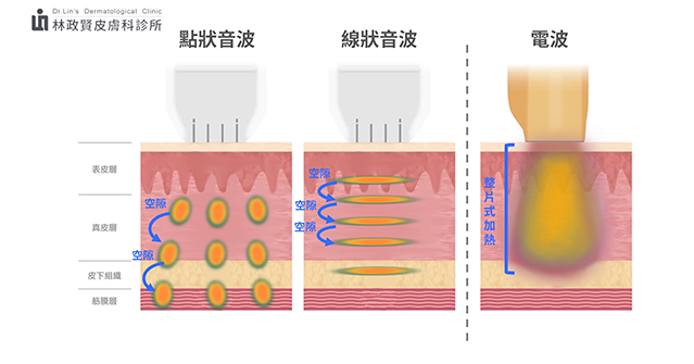 大s,天心,韓國,歐巴,音波拉提,linear線性探頭,醫美新趨勢,醫美新療程,緊緻拉提,緊緻脂肪,林政賢醫師,老化,抗老化,臉型,鳳凰電波,電波,雷射,bblsction,膠原蛋白,下垂,鬆弛,細紋,皺紋,肌膚老化,皮膚老化,老化肌膚,老化皮膚,眼周老化,眼周,眼周細紋,眼袋,淚溝,眼周保養,除細紋,眼尾下垂,眼下垂,消除細紋,除皺紋,音波,拉提,電波拉皮,音波拉皮,保養,美國音波,音波拉提ulthera,醫美,美容,點狀音波,線狀音波,脂肪破壞,嘴邊肉,雙下巴,q+音波 效果,q+ 海芙,海芙音波,音波拉提 電波拉提,電音雙波,thermage flx,q+音波 價格,午休美容,午覺美容,啦提借,拉提界新革命