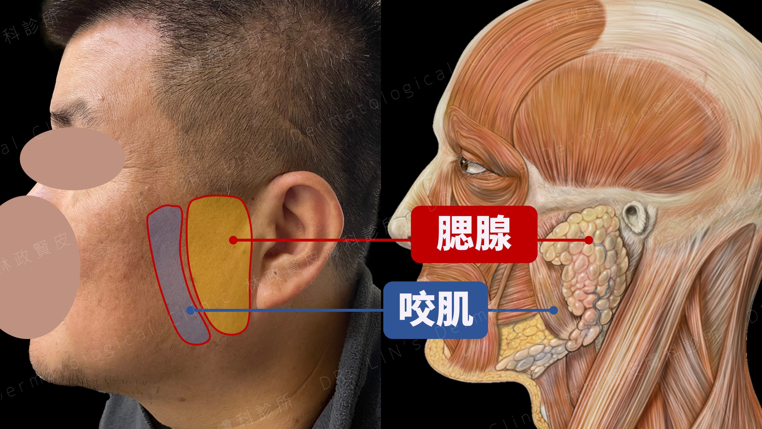 醫美,整形,微整形,玻尿酸,玻尿酸額頭,消脂針,頰凹,玻尿酸拉提,輪廓,醫美診所,醫美重要,微整,肉毒,肉毒咀嚼肌,醫美療程,保養,韓國醫美,肉毒瘦臉,淡化細紋,縮小毛孔,醫美,醫美診所,肉毒,肉毒桿菌,肉毒瘦臉,瘦臉針,整形,瘦臉心得,肉毒心得,美容,體驗,肉毒瘦小臉,效果,術後保養,微整形,後遺症,痘痘,咀嚼肌,小腿肌,手術,咬肌,手汗 肉毒,酒糟 肉毒,蘿蔔腿,國字臉,瓜子臉,瘦臉心得,美容體驗,皮膚管理,肉毒瘦小臉,微整,玻尿酸,瓜子臉,鵝蛋臉,肉毒瘦臉,抬頭紋,眼下細紋,動態眼下細紋,魚尾紋,肉毒 眼皮無力,肉毒 副作用,肉毒小臉,肉毒 平躺,肉毒價格,肉毒效果,肉毒除皺,朴敘俊