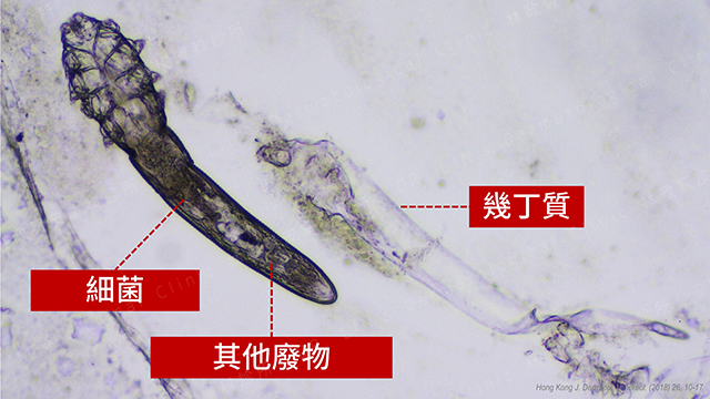 雷射術後,術前術後,痘疤治療,凹痘疤治療,疤痕治療,青春痘治療,up雷射,皮秒雷射,皮秒雷射術後保養,up雷射術後保養,術後照護,手術術後照顧,雷射術後照顧,雷射術後保養,清粉刺,清粉刺推薦,做臉,做臉推薦,爆痘,痘痘,長痘痘,做臉長痘,清粉刺長痘痘,爛痘,清完粉刺膿包,膿包,清完粉刺發炎,清痘痘,做臉恢復,做臉恢復期,皮膚保養,大爆痘,淡疤,淡痘疤,痘疤,粉刺,下巴粉刺,下巴長痘痘,臉長痘痘,皮秒雷射術後 爆痘,up雷射術後 爆痘,淨膚雷射術後 爆痘,飛梭雷射術後 爆痘,蝸牛精華液,雷射術後 敷面膜,雷射術後爆痘 林上立,雷射術後 大膿皰,太藤氏症,毛囊炎,酒糟,蠕形蟎蟲,青春痘,口服a酸,杜鵑花酸,過氧化苯,外用抗生素,外用a酸,roaccutane,羅可坦,副作用,成人痘,控油,毛孔粗大,果酸換膚,杏仁酸換膚,雷射,手術,雷射磨皮,外用藥物,口服藥物,換膚治療,小資族痘痘治療法,cp值高,痘疤治療法,局部抗生素,局部抗發炎,三氯醋酸換膚,痘膚潤,differin,雷射術後爆痘