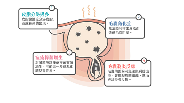 青春痘,痘痘,口服a酸,杜鵑花酸,過氧化苯,外用抗生素,外用a酸,roaccutane,羅可坦,副作用,成人痘,控油,毛孔粗大,果酸換膚,杏仁酸換膚,雷射,外用藥物,口服藥物,換膚治療,cp值高,痘疤治療法,局部抗生素,局部抗發炎,三氯醋酸換膚,痘膚潤,differin,背部痘痘,背部 黑色痘疤,背部痘痘治療,背部痘痘 改善,背部痘痘怎麼消,背部痘痘藥膏,背部痘痘 果酸換膚,背部痘痘處理,海菲秀 背部痘痘,背部長痘痘,芽孢菌毛囊炎,細菌性毛囊炎,痤瘡桿菌,背部凸疤,背部蟹足腫,背 痘痘,背后长痘痘,背部长痘,杜鵑花酸 痘疤,背 痘痘 原因,背痘 疤,背部痘痘 醫美,背部痘痘淡化,背部痘痘肥皂,背部痘痘皮膚科,背 痘痘 dcard,背部長痘痘 原因,果酸乳液