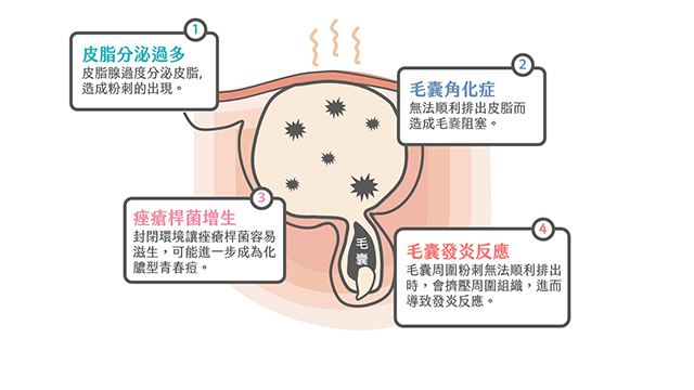  紅光儀,口服a酸,roaccutane,羅可坦,歐霓光療儀,omnilux