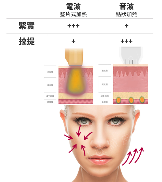 音波拉提,linear,緊緻拉提,老化,抗老化,臉型,鳳凰電波,膠原蛋白,下垂,鬆弛,肌膚老化,皮膚老化,老化肌膚,老化皮膚,眼周老化,眼周,眼周細紋,消除細紋,電波拉皮,美國音波,音波拉提ulthera,點狀音波,線狀音波,脂肪破壞,嘴邊肉,雙下巴,海芙音波,音波拉提 電波拉提,電音雙波,thermage,臉下垂,臉下垂 改善,皮膚鬆垮 電波,皮膚鬆垮 音波,嘴邊肉下垂面相,木偶紋消除,木偶紋 醫美,木偶紋 電波,嘴邊肉電音波,臉下垂 埋線,埋線拉提,膠原蛋白 流失,膠原蛋白變性,膠原蛋白 填充,舒顏萃,玻尿酸 拉提,intragen