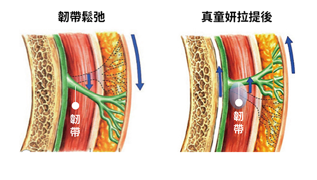 嘴邊肉,木偶紋,嬰兒肥,臉大,電波,音波,拉提嘴邊肉,真童妍,玻尿酸拉提,晶亮瓷,埋線拉提