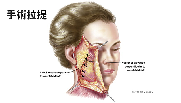 嘴邊肉,木偶紋,嬰兒肥,臉大,電波,音波,拉提嘴邊肉,真童妍,玻尿酸拉提,晶亮瓷,埋線拉提,真童妍,玻尿酸,晶亮瓷,手術拉提