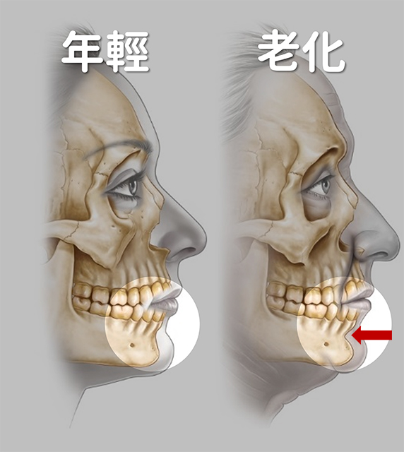 嘴邊肉,木偶紋,嬰兒肥,臉大,電波,音波,拉提嘴邊肉,真童妍,玻尿酸拉提,晶亮瓷,埋線拉提,真童妍,玻尿酸,晶亮瓷,手術拉提