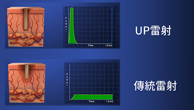 手術除疤,蟹足腫 雷射,肥厚性疤痕,排氣管 疤痕,除疤雷射,除疤凝膠,up雷射 蟹足腫,傷口 不留疤,傷口癒合 加快,凹陷疤痕 治療,剖腹產 疤痕,外傷疤痕,受傷留疤,如何除疤,受傷疤痕,up雷射除疤,排氣管燙到,水痘疤,蟹足腫,紅疤,黑疤,色素沉澱,色素沉澱 改善,up雷射 除疤,除疤膏 比较,除疤膏 痘疤,up雷射 蟹足肿,傷口愈合過程,傷口如何不留疤,傷口縫合,疤痕,疤痕治療,燒燙傷 不留疤,手術疤痕淡化,縫合疤痕,車禍疤痕,皮膚發炎,疤痕體質,疤痕增生如何消除,肥厚疤痕,疤痕 雷射,白疤痕,凸疤 治療,肥厚疤痕 治疗,防疤凝膠,除疤,除疤藥膏,皮膚科,留疤,淡疤,除疤治療,倍舒痕,施舒雅疤痕護理凝膠,倍舒痕 用法,dermatix® ultra,rejuvasil®silicone scar gel,去疤膏,除疤贴,矽膠貼片,淡化疤痕,除疤貼片,up雷射 蟹足腫,疤痕增生,突疤,凸疤,凸痘疤,染料雷射,脈衝染料雷射,585黃雷射,肉毒桿菌素注射,up雷射,ultrapulse