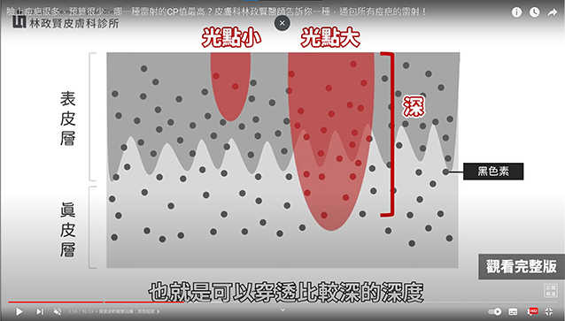 青春痘,痘疤,黑疤,黑痘疤,黑痘印,紅痘疤,紅痘印,紅疤,染料雷射,黃雷射,皮秒雷射,探索皮秒雷射,585黃雷射,凹疤,凹洞,up雷射,ultrapulse,皮下剝離,皮下切割,subcision,真皮移植,凹疤提升術,穿刺提升術,punch,elevation,褐痘疤,凹痘疤,飛梭雷射,杜鵑花酸,外用a酸,口服a酸,黑色痘疤,黑色素沉澱,表皮型色素沉澱,真皮型色素沉澱,紅色痘疤,凸痘疤 治療,義大利超跑,凹痘疤 皮秒雷射,紅色痘疤 皮秒雷射,黑色痘疤 皮秒雷射,up雷射,外用a酸,口服a酸,疤痕,毛孔粗大,超脈衝,極速脈衝,二氧化碳雷射,車廂型,廂車型,冰鑿型,外傷,月球表面,反黑,反紅,高雄治療痘疤,淨膚雷射,痘印,磨皮雷射,汽化式雷射,蜂巢皮秒,雷射術後,痘疤治療,凹痘疤治療,疤痕治療,皮秒雷射術後保養,up雷射術後保養,雷射術後保養,爆痘,淡疤,淡痘疤,皮秒雷射術後 爆痘,控油,果酸換膚,杏仁酸換膚,雷射,手術,雷射磨皮,痘疤治療法,雷射術後爆痘,凸痘疤,蟹足腫,肥厚性疤痕,picoway,picosure,discovery pico laser