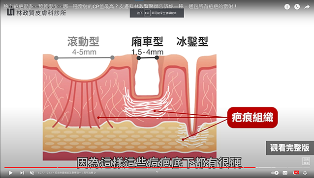 青春痘,痘疤,黑疤,黑痘疤,黑痘印,紅痘疤,紅痘印,紅疤,染料雷射,黃雷射,皮秒雷射,探索皮秒雷射,585黃雷射,凹疤,凹洞,up雷射,ultrapulse,皮下剝離,皮下切割,subcision,真皮移植,凹疤提升術,穿刺提升術,punch,elevation,褐痘疤,凹痘疤,飛梭雷射,杜鵑花酸,外用a酸,口服a酸,黑色痘疤,黑色素沉澱,表皮型色素沉澱,真皮型色素沉澱,紅色痘疤,凸痘疤 治療,義大利超跑,凹痘疤 皮秒雷射,紅色痘疤 皮秒雷射,黑色痘疤 皮秒雷射,up雷射,外用a酸,口服a酸,疤痕,毛孔粗大,超脈衝,極速脈衝,二氧化碳雷射,車廂型,廂車型,冰鑿型,外傷,月球表面,反黑,反紅,高雄治療痘疤,淨膚雷射,痘印,磨皮雷射,汽化式雷射,蜂巢皮秒,雷射術後,痘疤治療,凹痘疤治療,疤痕治療,皮秒雷射術後保養,up雷射術後保養,雷射術後保養,爆痘,淡疤,淡痘疤,皮秒雷射術後 爆痘,控油,果酸換膚,杏仁酸換膚,雷射,手術,雷射磨皮,痘疤治療法,雷射術後爆痘,凸痘疤,蟹足腫,肥厚性疤痕,picoway,picosure,discovery pico laser